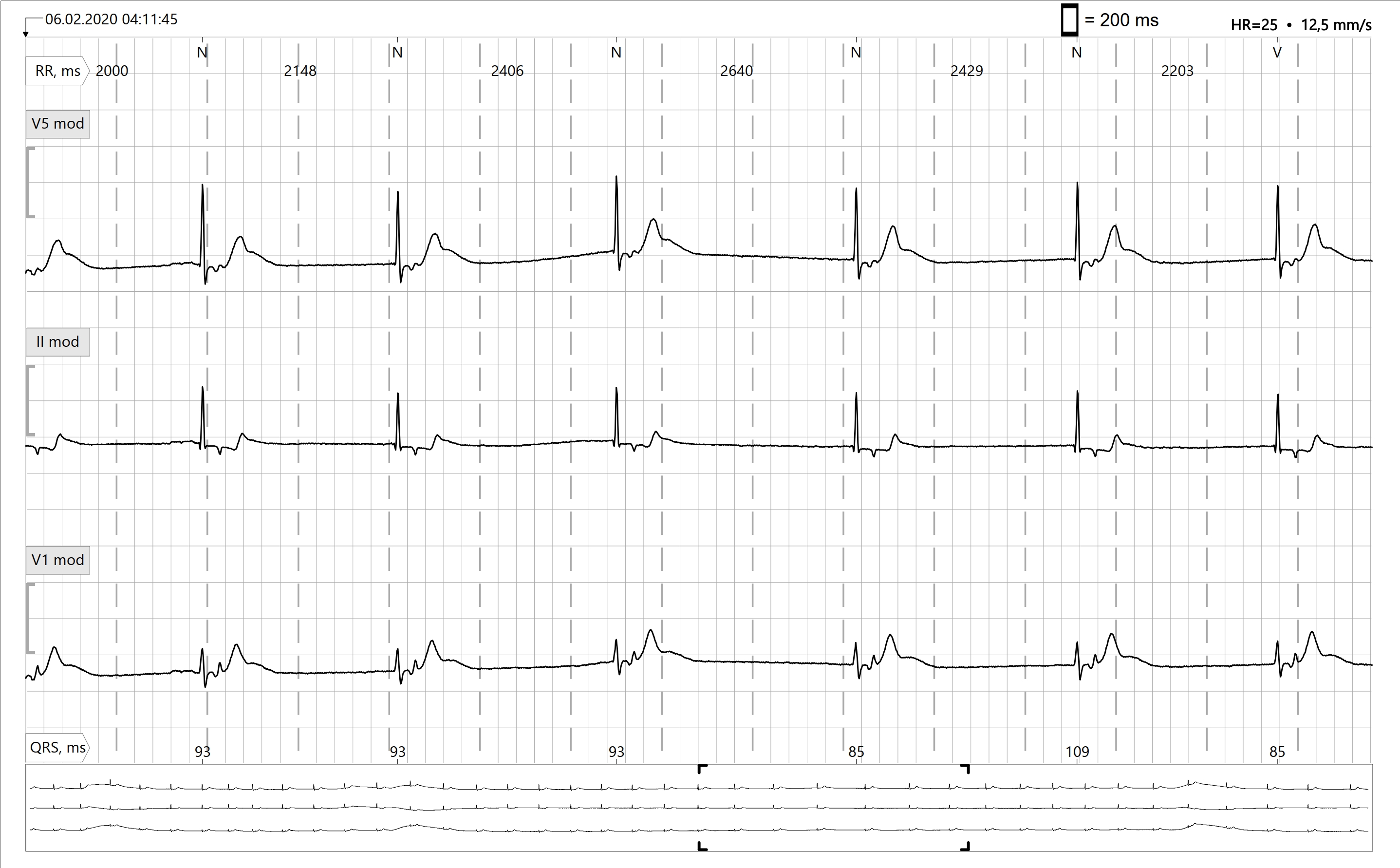 Junctional Rhythm ECG Guru Instructor Resources